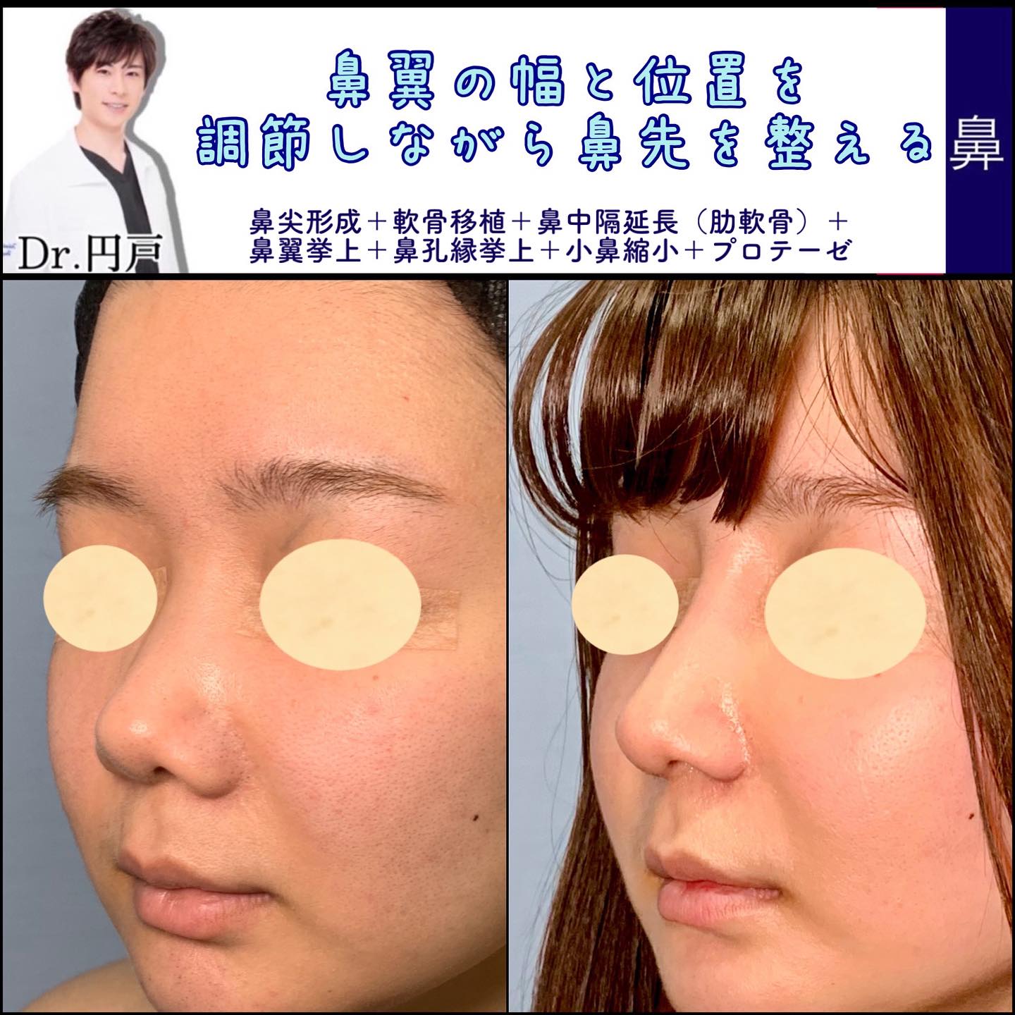 鼻尖形成と軟骨移植と鼻中隔延長と鼻翼挙上と鼻孔縁挙上と小鼻縮小とプロテーゼの症例写真 (2)
