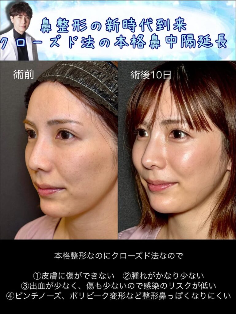 クローズド法の鼻中隔延長の症例動画 (1)