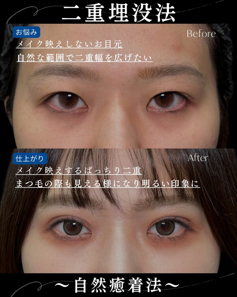 自然癒着法の症例写真 (4)