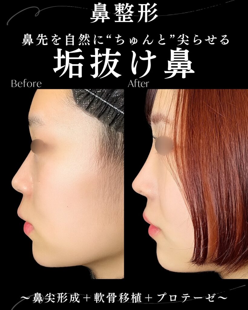 鼻尖形成と軟骨移植とプロテーゼの症例写真 (2)