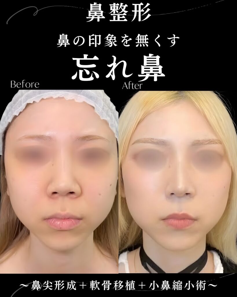 鼻尖形成と軟骨移植と小鼻縮小の症例写真