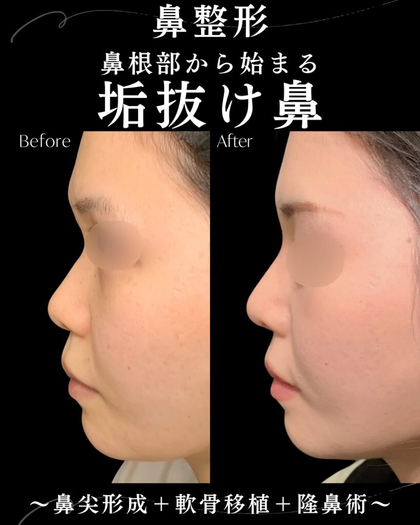 鼻尖形成と軟骨移植とプロテーゼの症例写真