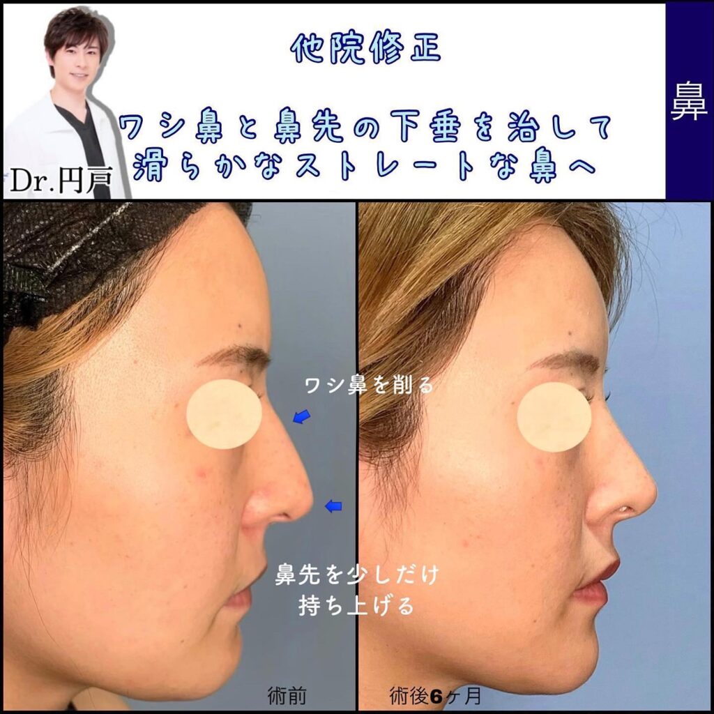 他院鼻修正術の症例写真 (1)