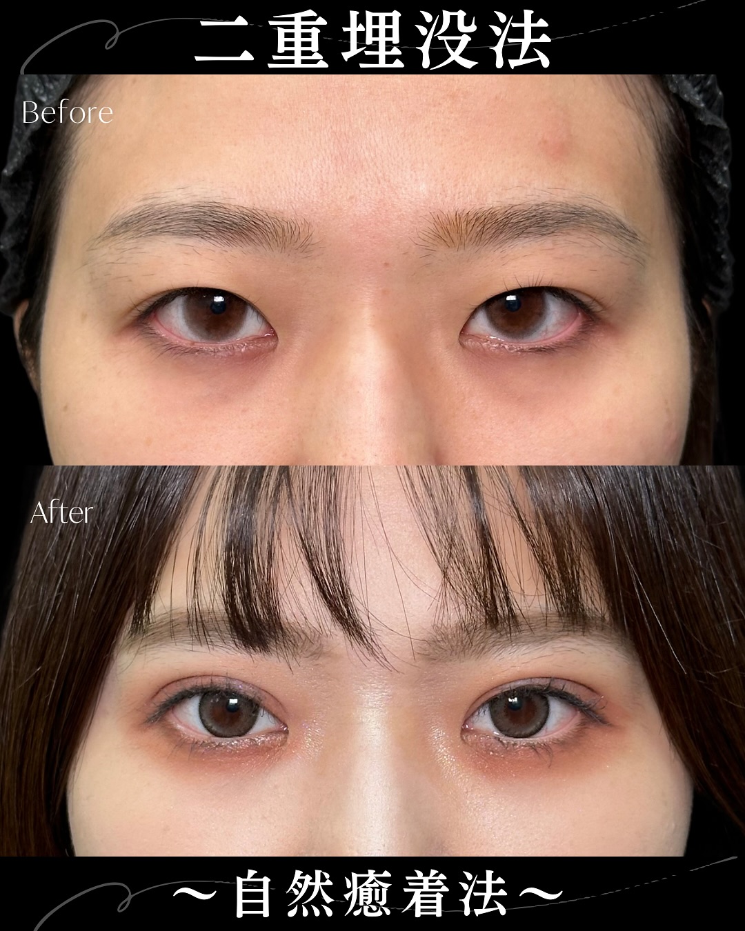 自然癒着法の症例写真 (8)