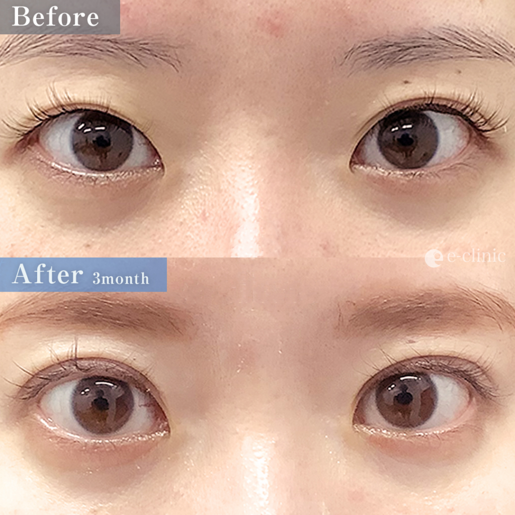 全切開法と埋没糸抜糸併用の症例写真 (1)