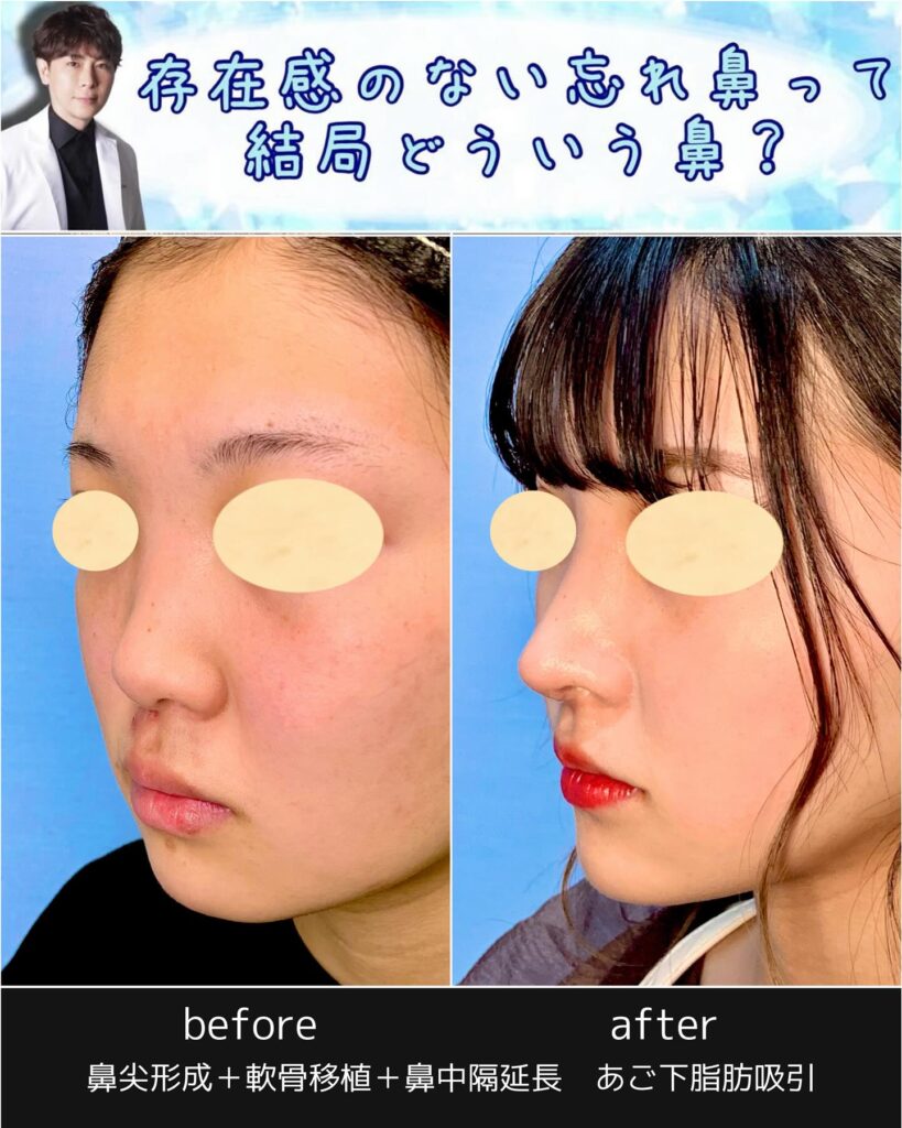 鼻尖形成と軟骨移植と鼻中隔延長と顎下の脂肪吸引の症例写真