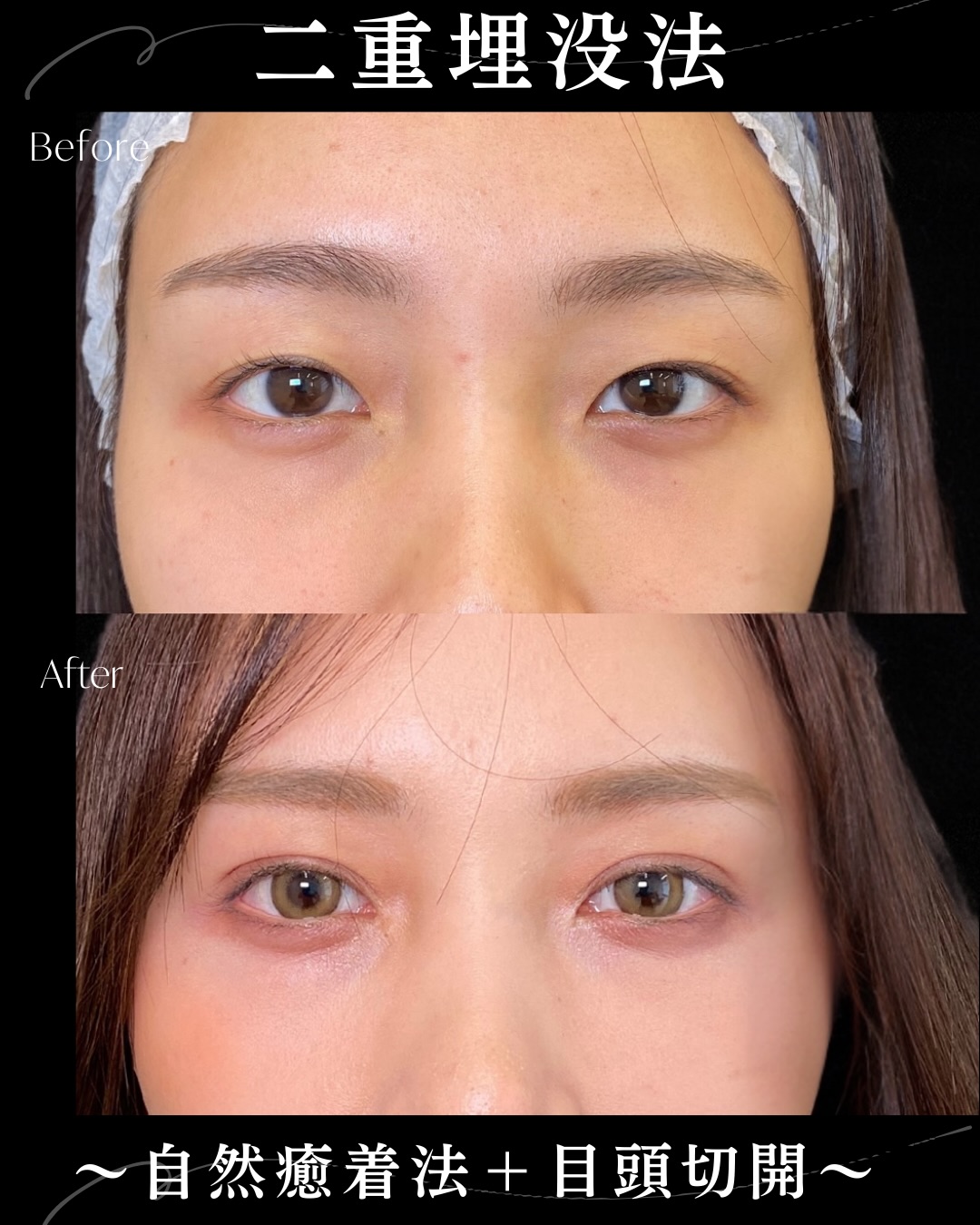 自然癒着法と目頭切開の症例写真 (4)