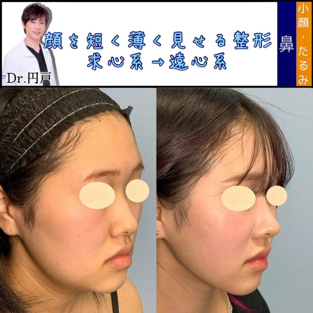 目尻切開と目尻靭帯移動とタレ目形成と眉下切開と鼻のプロテーゼと鼻尖形成と軟骨移植と鼻中隔延長と小顔脂肪吸引と脂肪注入と糸リフトと貴族手術の症例写真 (2)