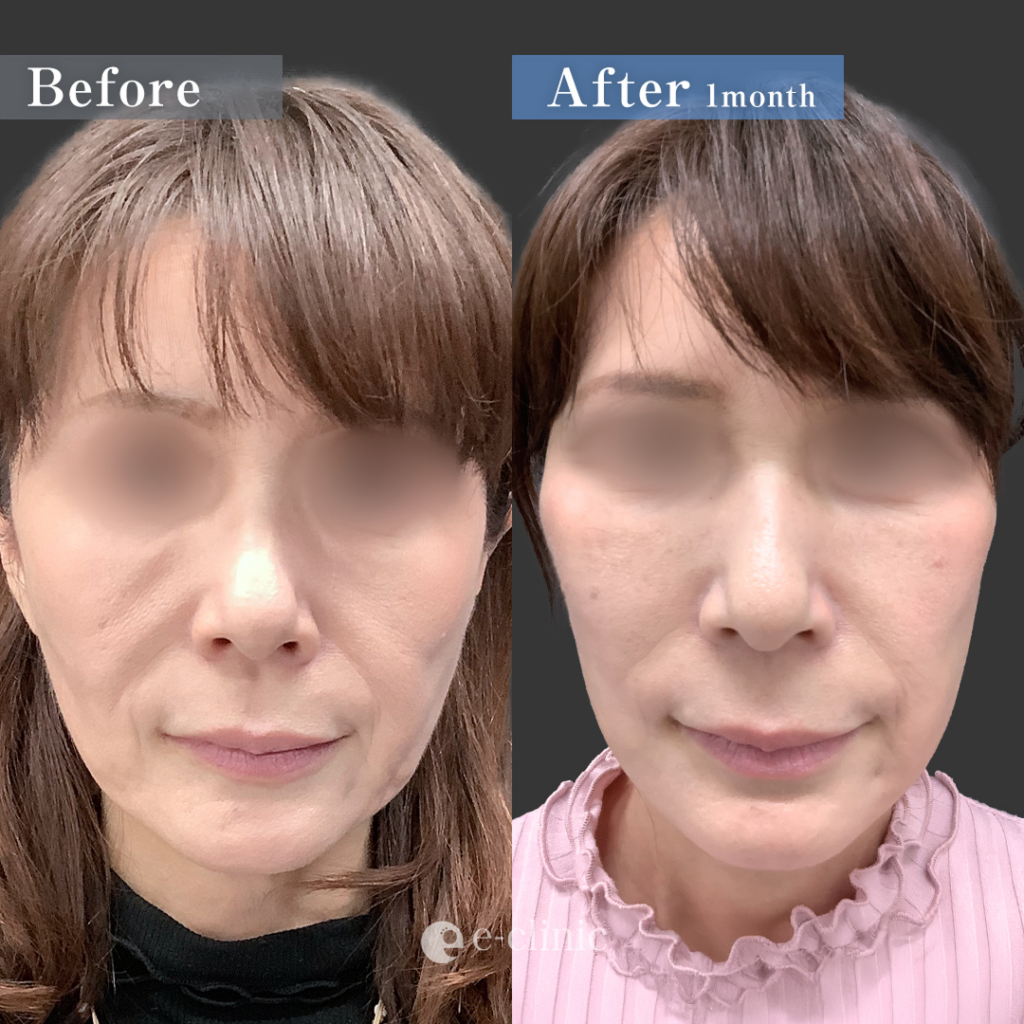 スマスフェイスリフトとネックリフトとミッドフェイスリフト（中顔面リフト）とこめかみリフトの症例写真 (1)