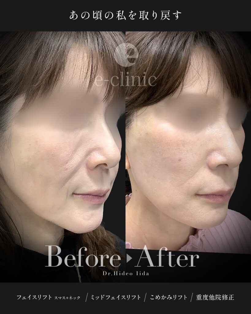 スマスフェイスリフトとネックリフトとミッドフェイスリフト（中顔面リフト）とこめかみリフトの症例写真 (1)