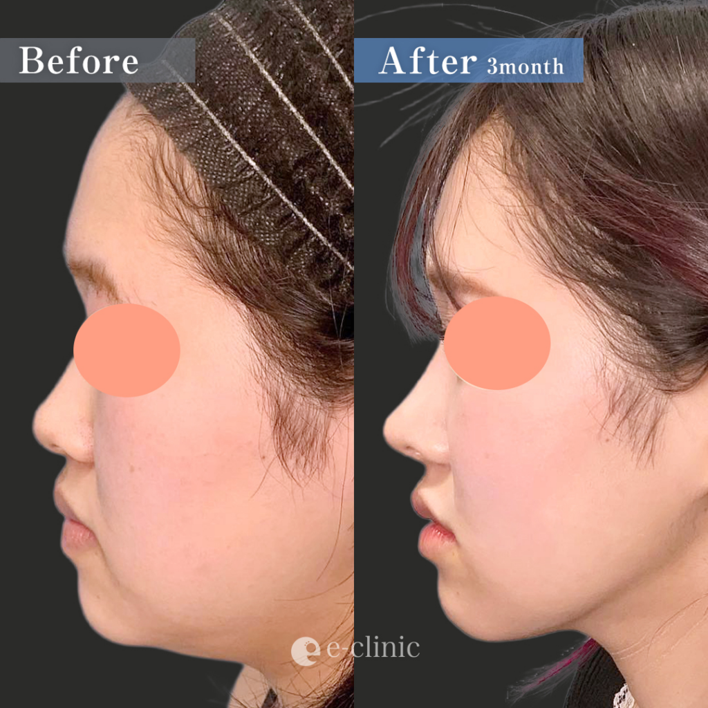 目尻切開と目尻靭帯移動とタレ目形成と眉下切開と鼻のプロテーゼと鼻尖形成と軟骨移植と鼻中隔延長と小顔脂肪吸引と脂肪注入と糸リフトと貴族手術の症例写真 (2)