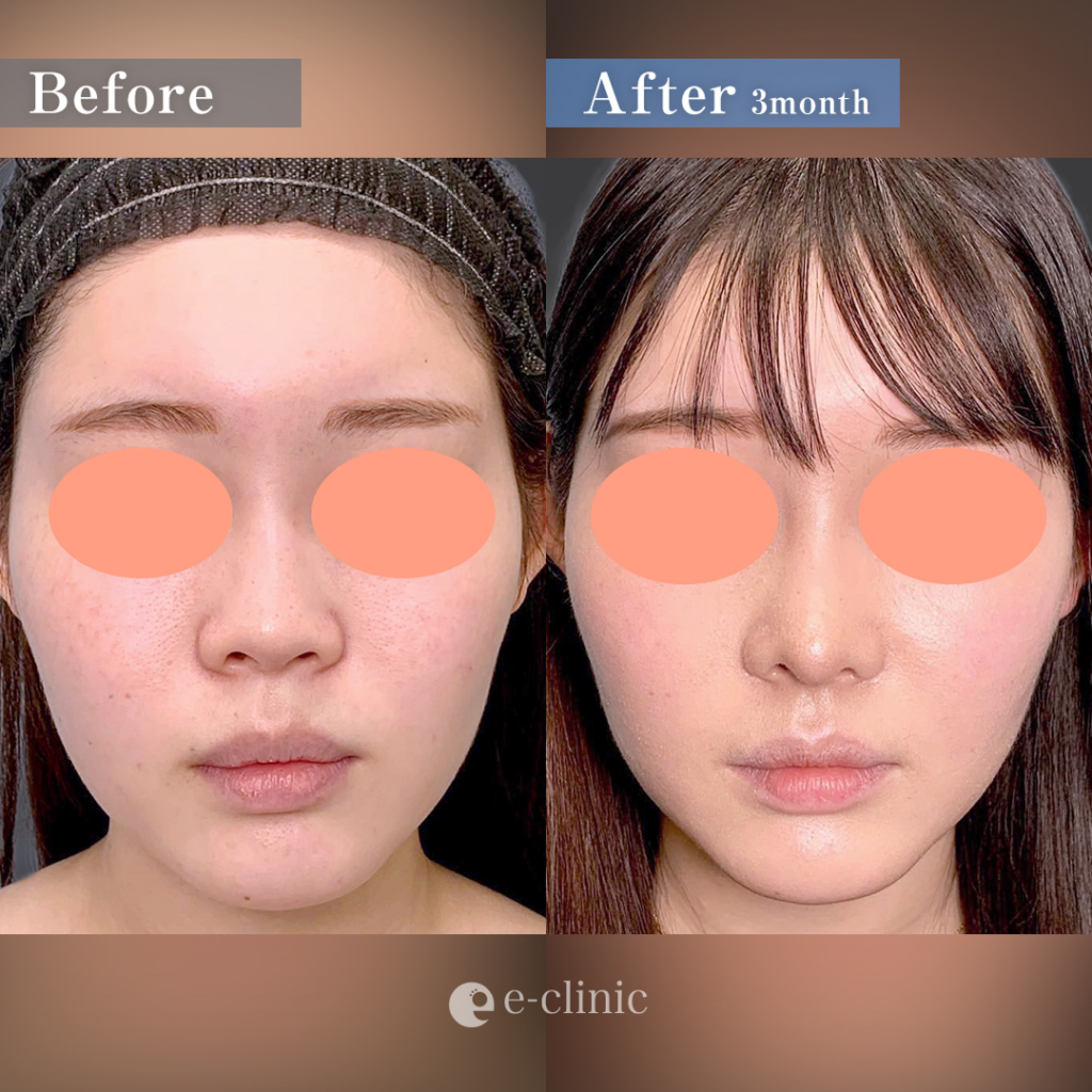 鼻中隔延長と軟骨移植と鼻尖形成と貴族手術の症例写真 (4)