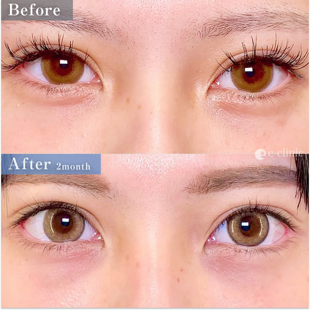 目尻切開（目尻靭帯移動）とタレ目（グラマラス）形成の症例写真