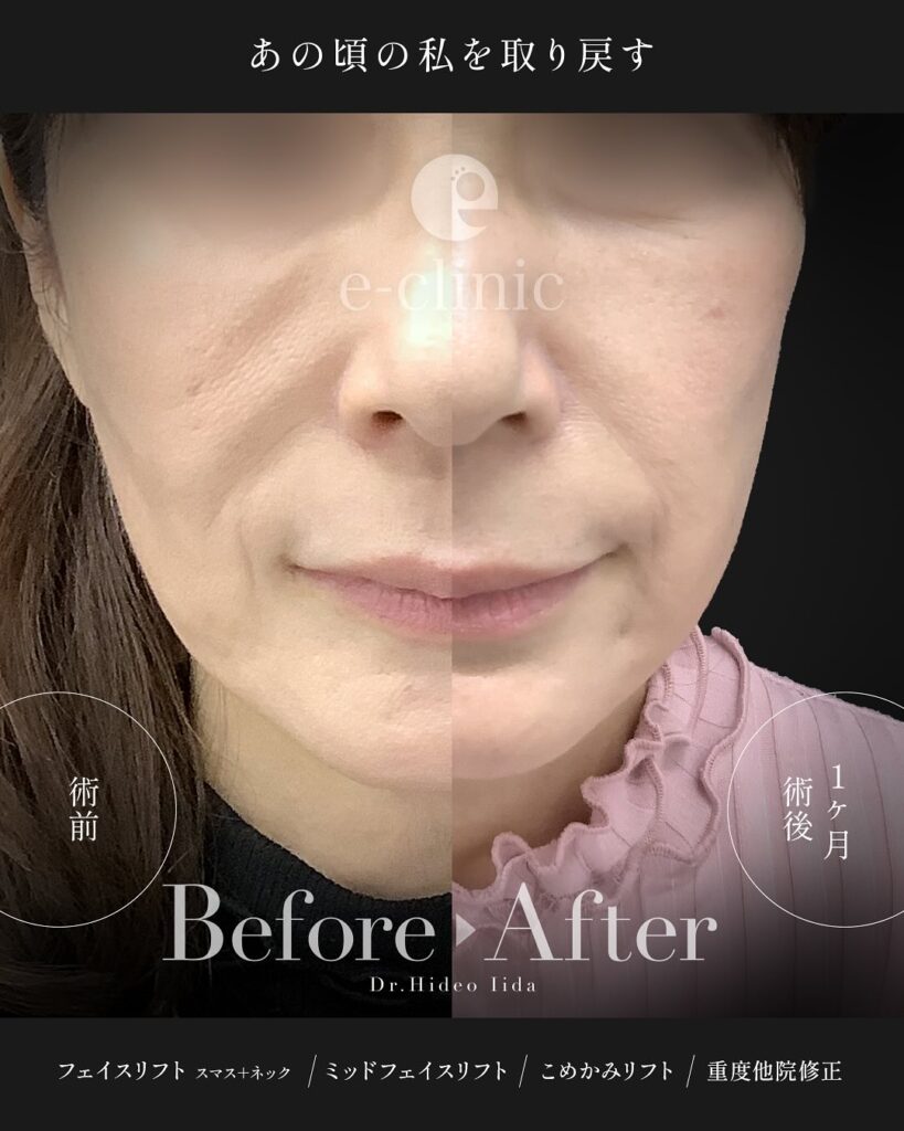 スマスフェイスリフトとネックリフトとミッドフェイスリフト（中顔面リフト）とこめかみリフトの症例写真 (4)