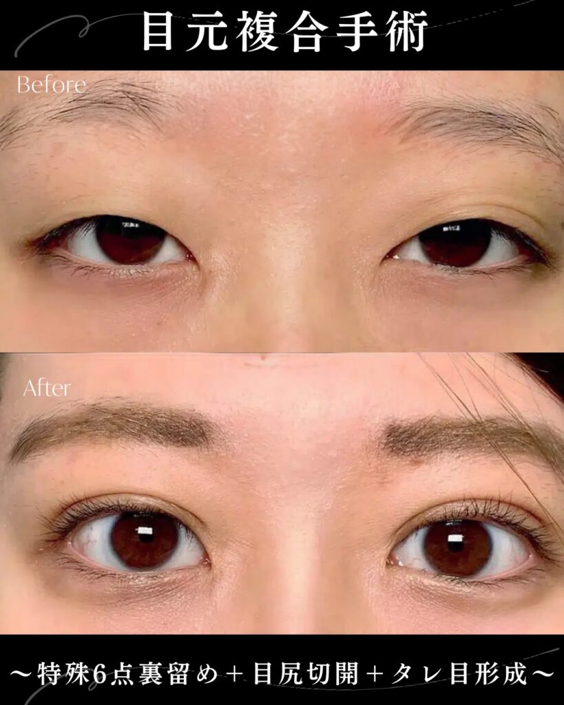埋没法と目尻切開とタレ目形成の症例写真