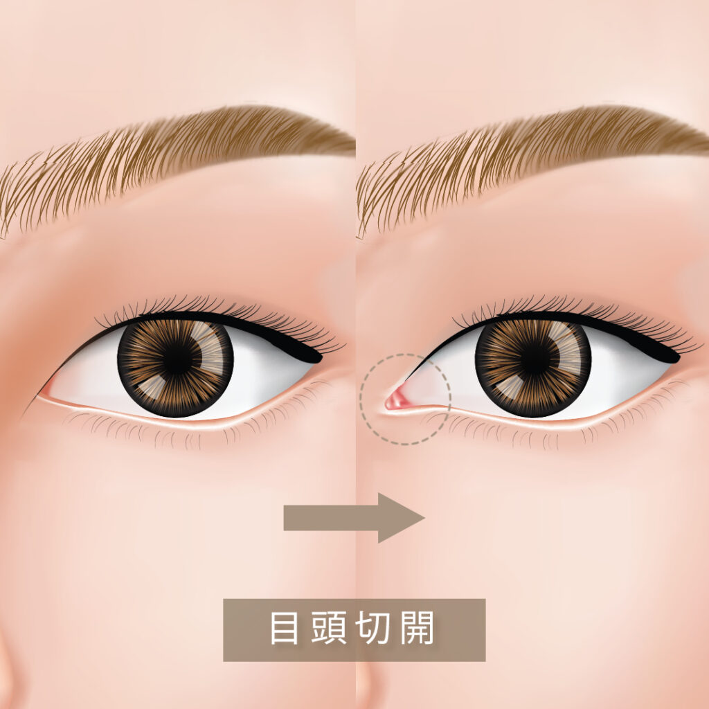 目頭切開の図解