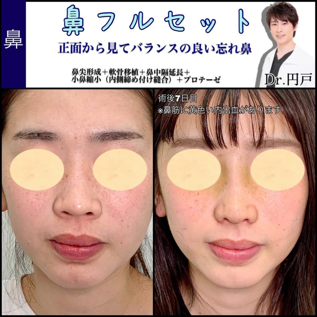 鼻尖形成、軟骨移植、鼻中隔延長、小鼻縮小、プロテーゼを同時に行った１週間後の症例写真