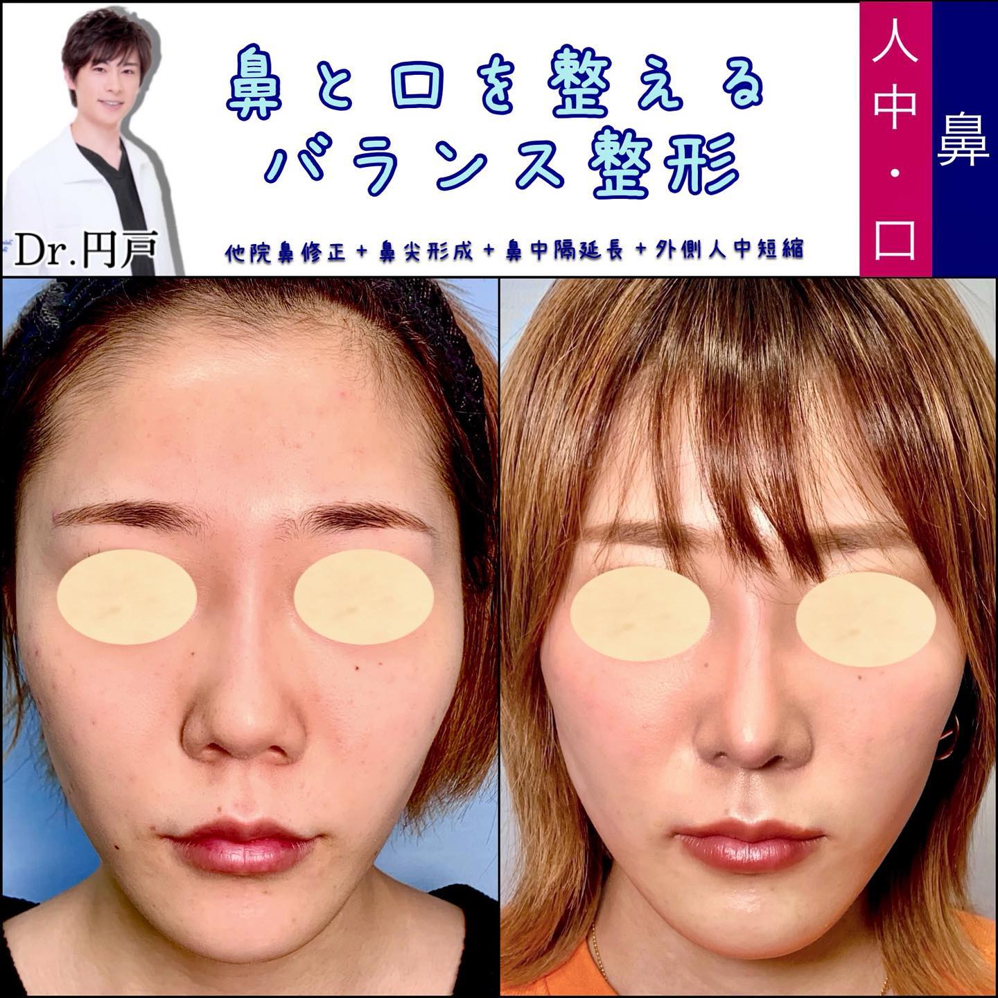 鼻中隔延長、軟骨移植、鼻尖形成、鼻柱下降、外側人中短縮を行った症例写真