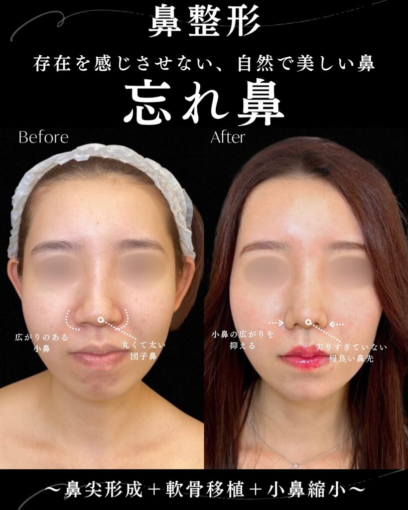 鼻尖形成と軟骨移植と小鼻縮小の症例写真 (9)