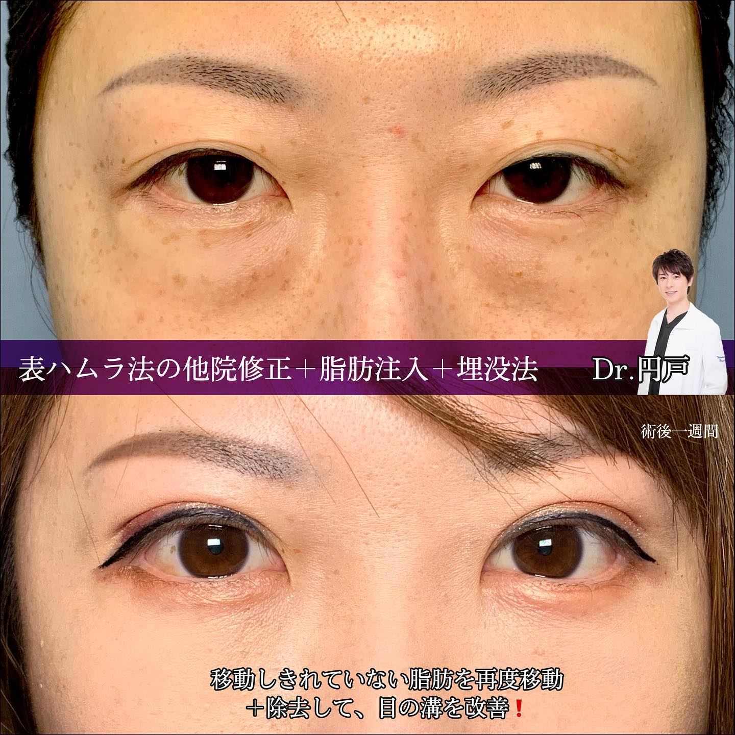 表ハムラ法の他院修正と脂肪注入と埋没法の症例写真 (1)