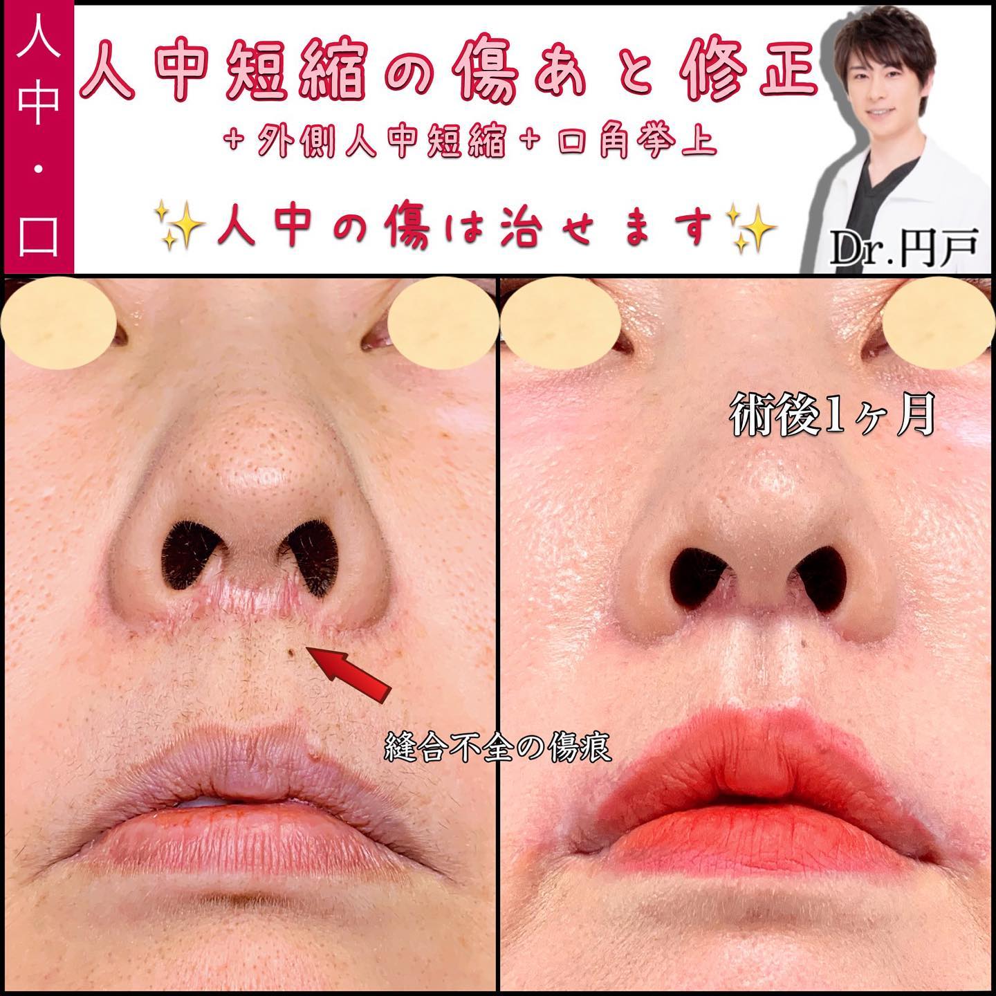 人中短縮の傷痕修正と外側人中短縮と口角挙上の症例写真