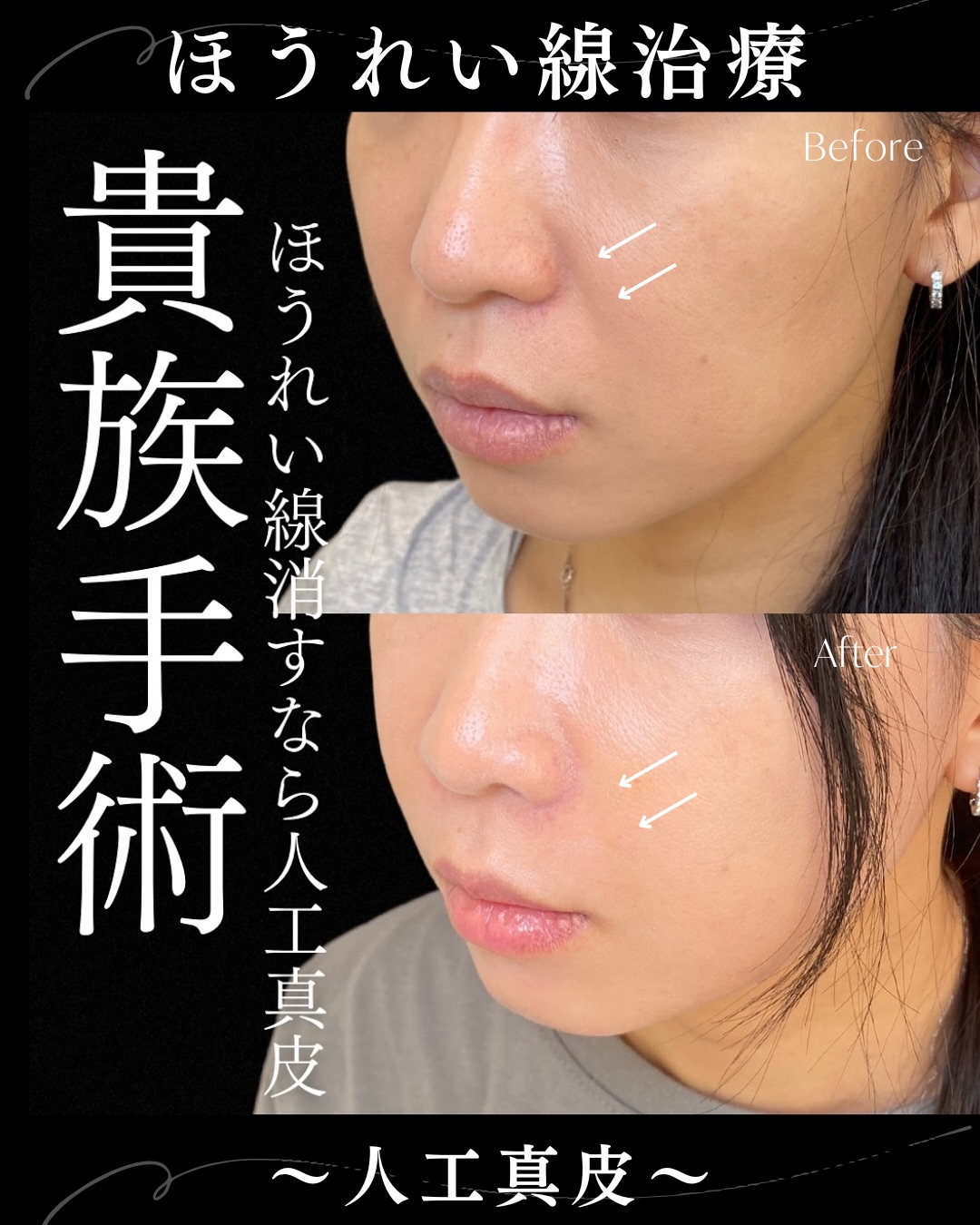 貴族手術の症例写真 (5)