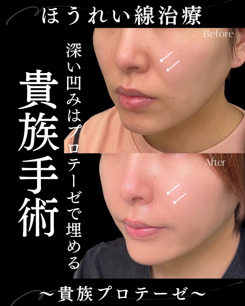 貴族手術の症例写真 (4)