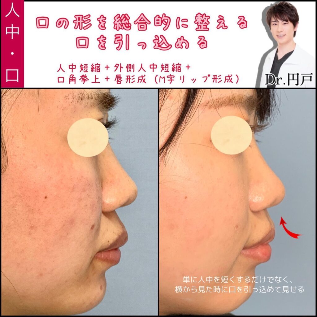 人中短縮と外側人中短縮と口角挙上とＭ字リップの症例写真 (2)