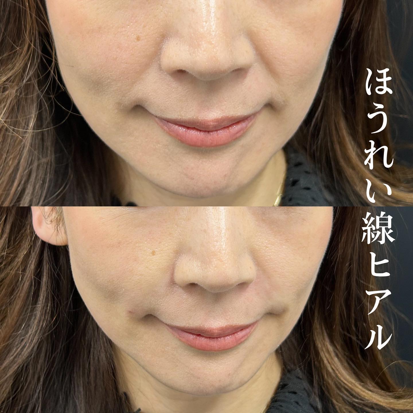 ほうれい線にヒアルロン酸を注入した症例写真