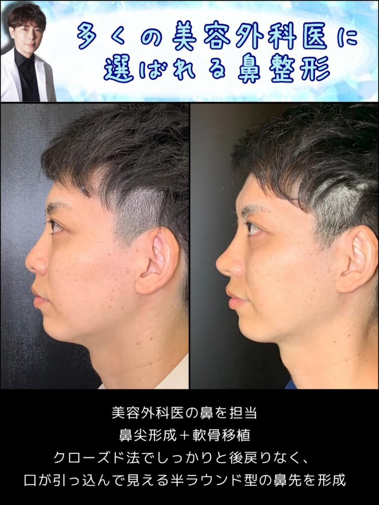 男性のクローズド法の鼻整形の症例