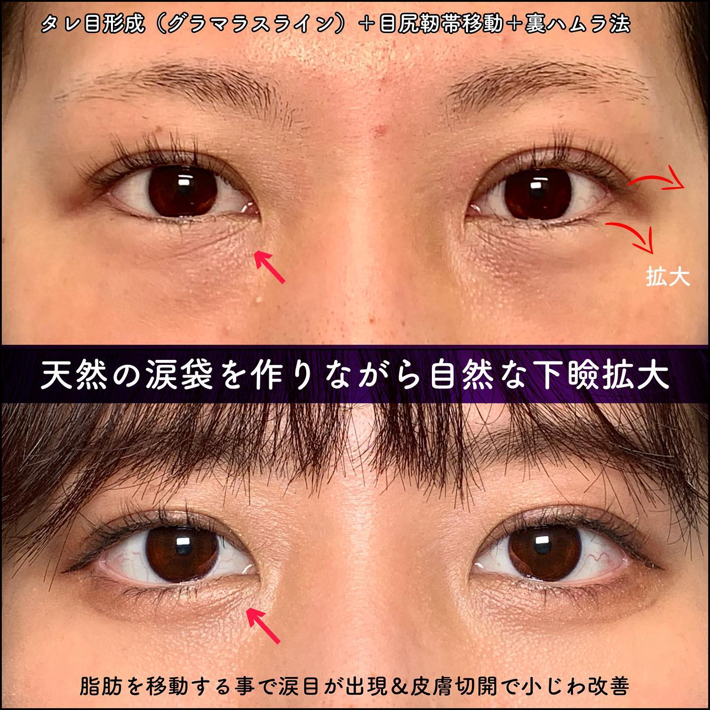 タレ目形成と目尻靭帯移動と裏ハムラ法の症例写真 (1)