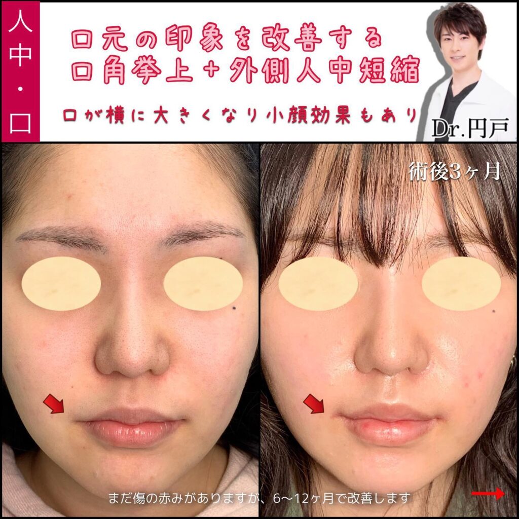 口角挙上と外側人中短縮を同時に行った3か月後の症例