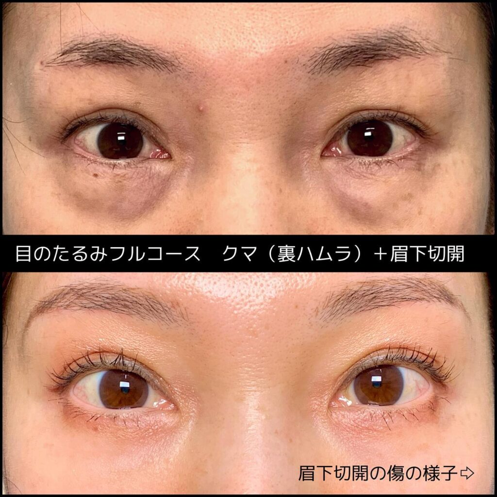 裏ハムラ法と目尻切開の症例写真