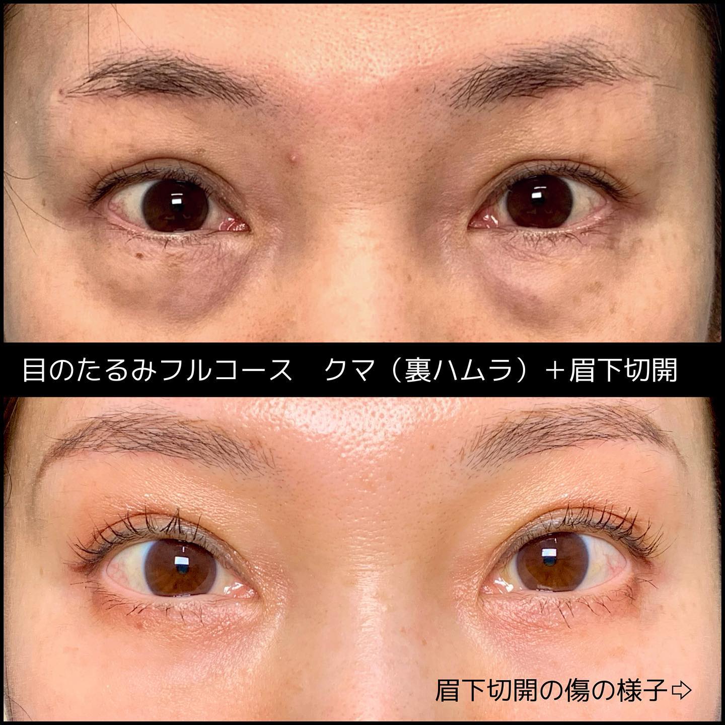 裏ハムラ法と目尻切開の症例写真