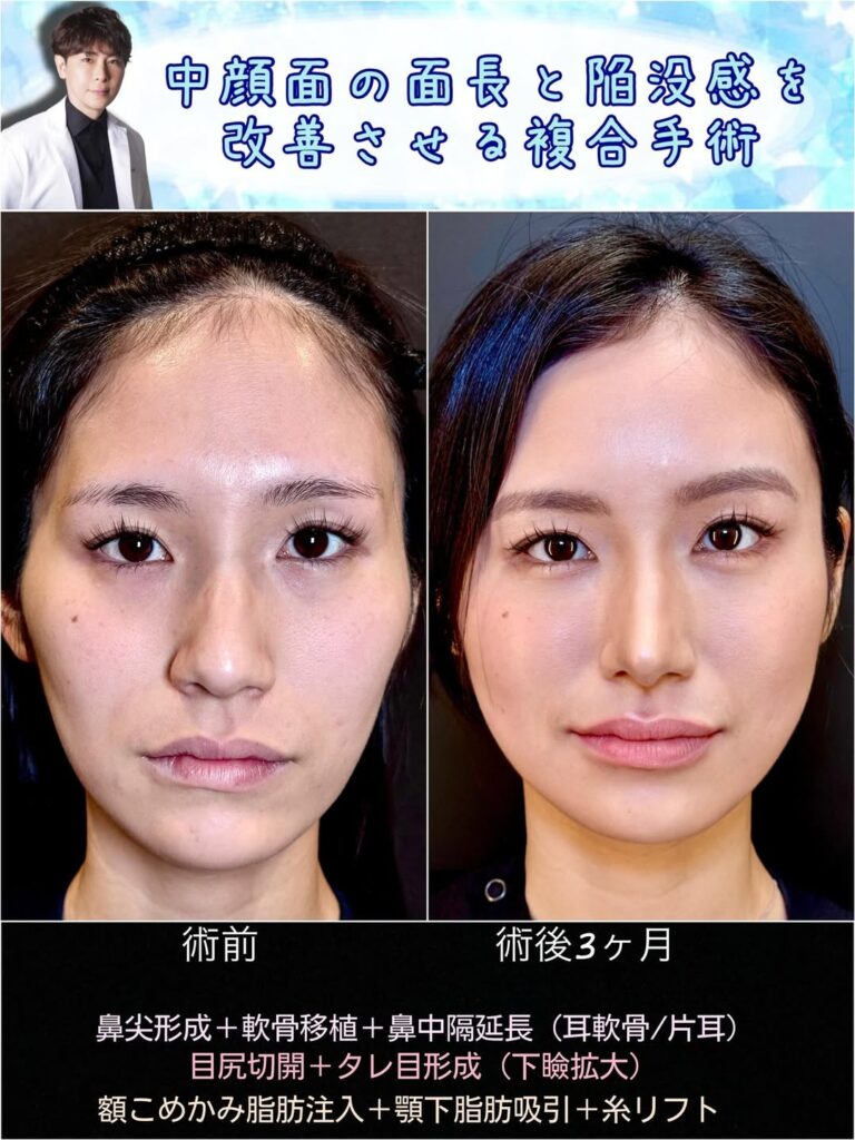 鼻尖形成と軟骨移植と鼻中隔延長と目尻切開とタレ目形成と脂肪注入と顎下の脂肪吸引とヒアルロン酸の症例写真 (1)