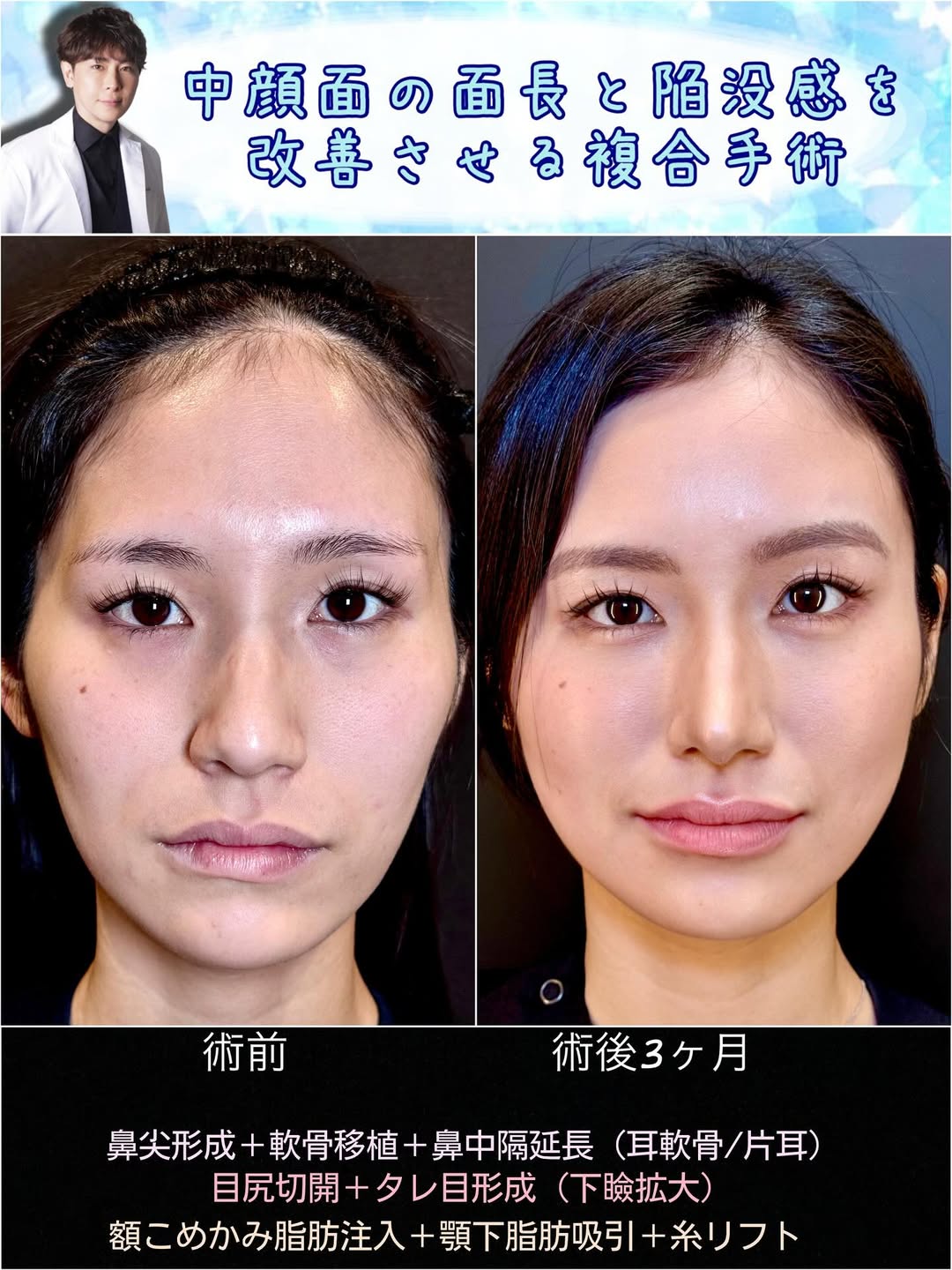 鼻尖形成と軟骨移植と鼻中隔延長と目尻切開とタレ目形成と脂肪注入と顎下の脂肪吸引とヒアルロン酸の症例写真 (1)