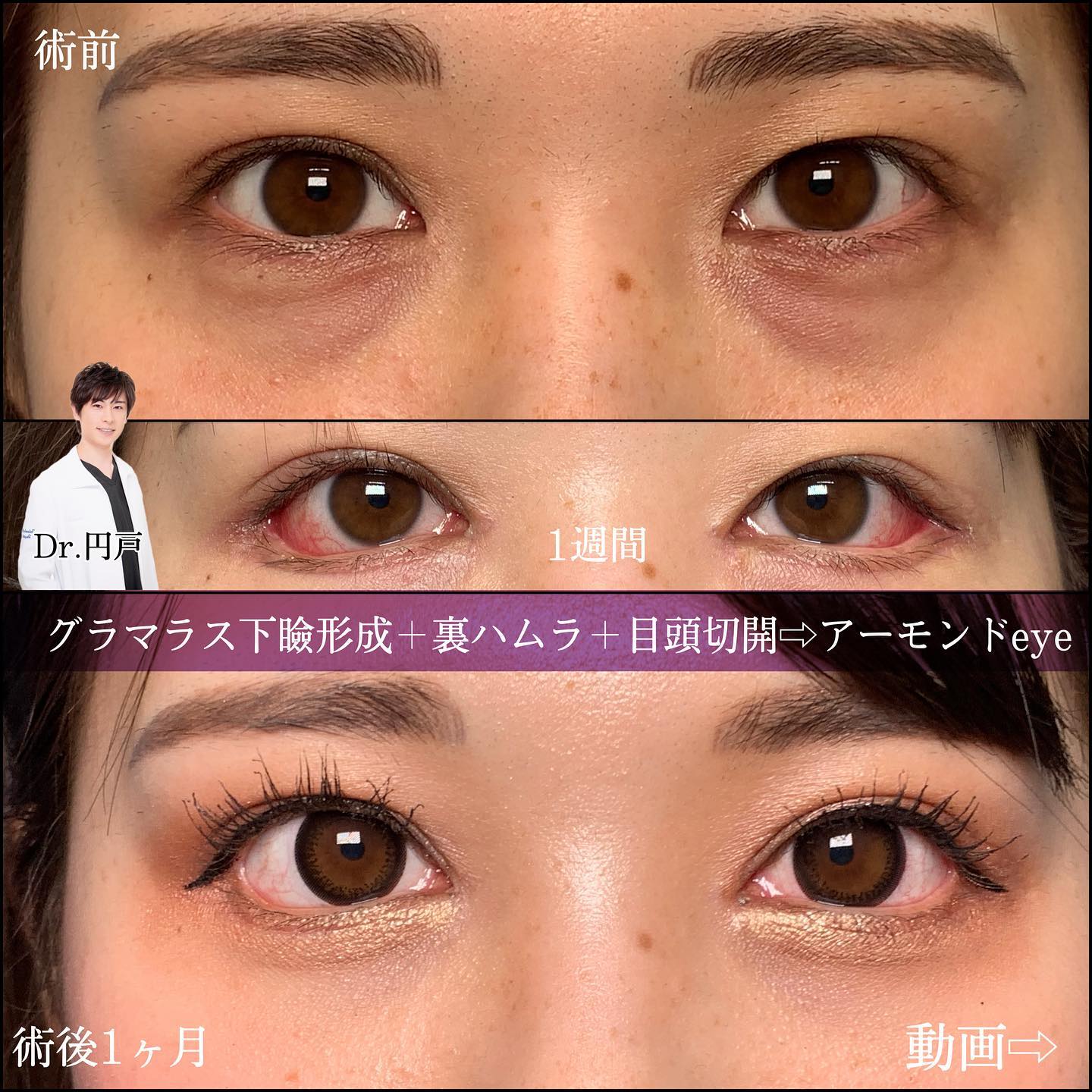 タレ目形成と裏ハムラ法と目頭切開の症例写真