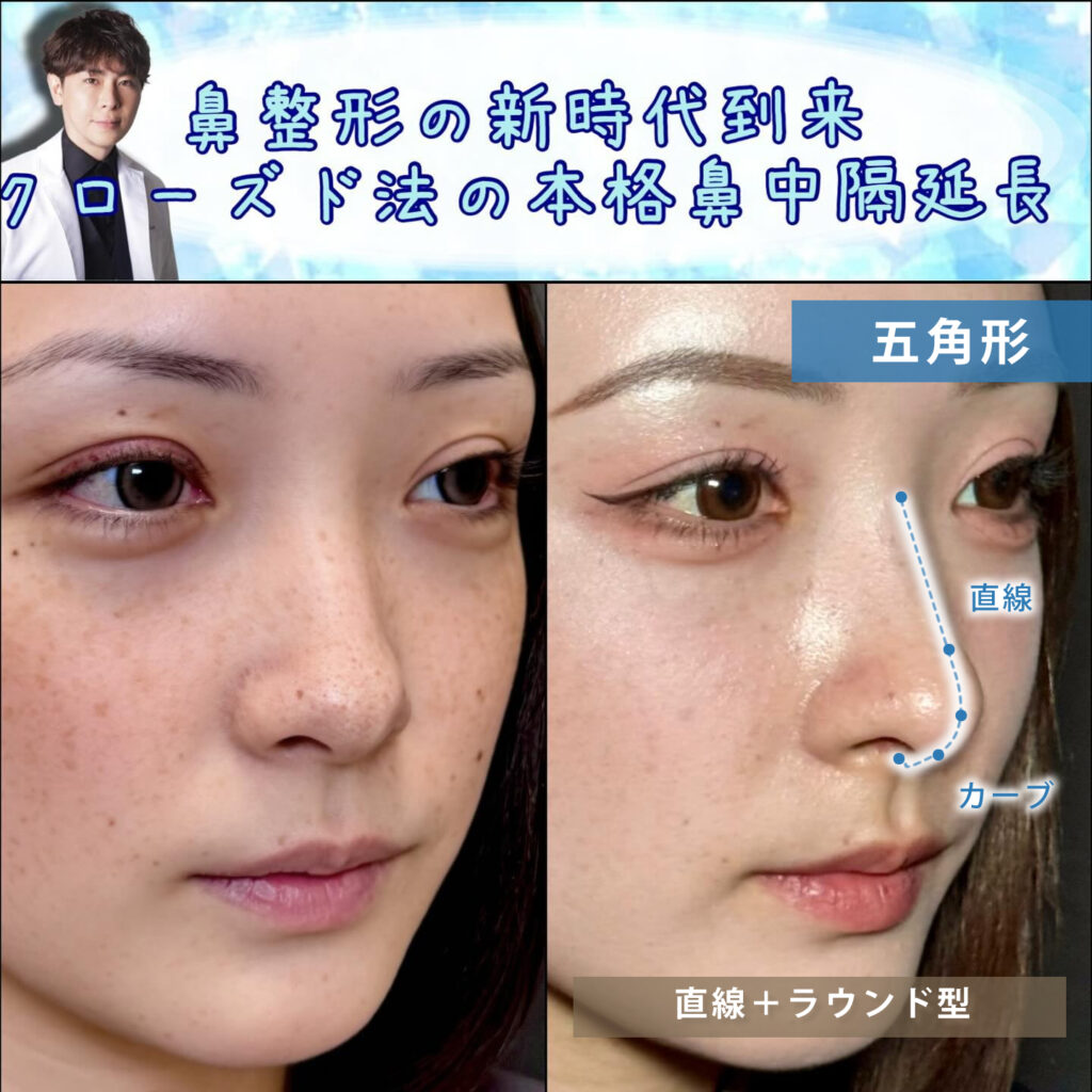 斜めから見た傷がない鼻中隔延長の症例写真