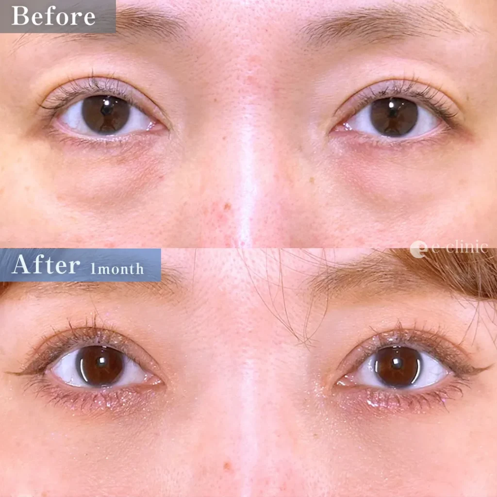 クマ取り_裏ハムラ法＋ナノリッチ（劉奕陽）（51）