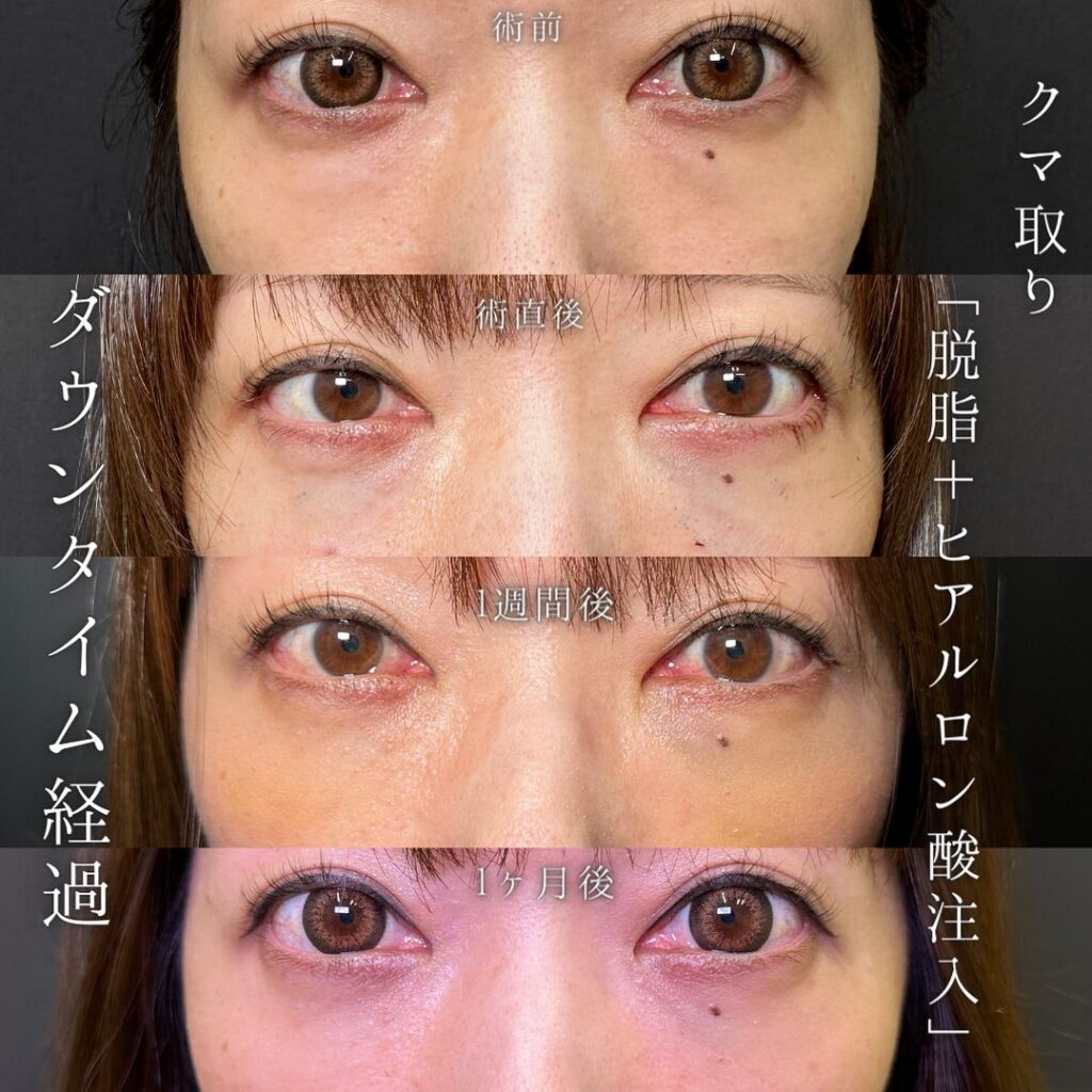 経結膜脱脂のクマ取りの直後と１週間後と１か月後の経過の症例