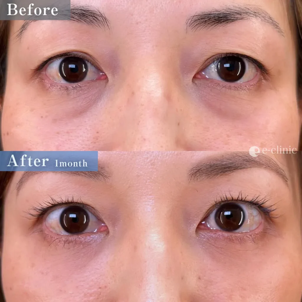 クマ取り_裏ハムラ法（島田）（2）