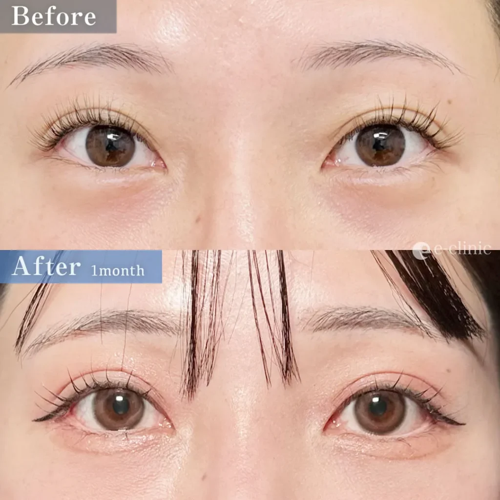 タレ目形成＋クマ取り_脱脂＋脂肪注入（伊藤渉）（167）