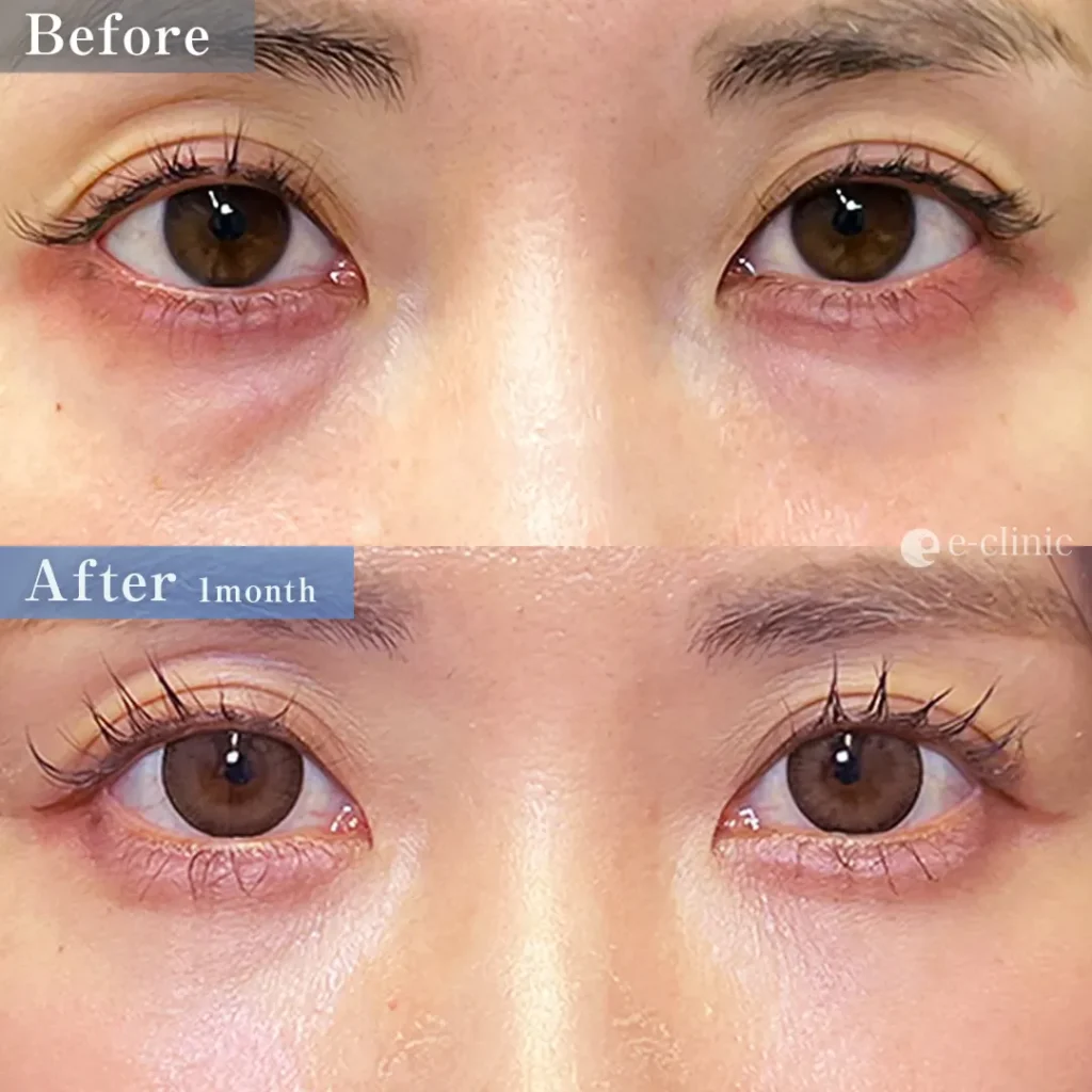 クマ取り_経血膜脱脂＋脂肪注入（劉奕陽）（47）