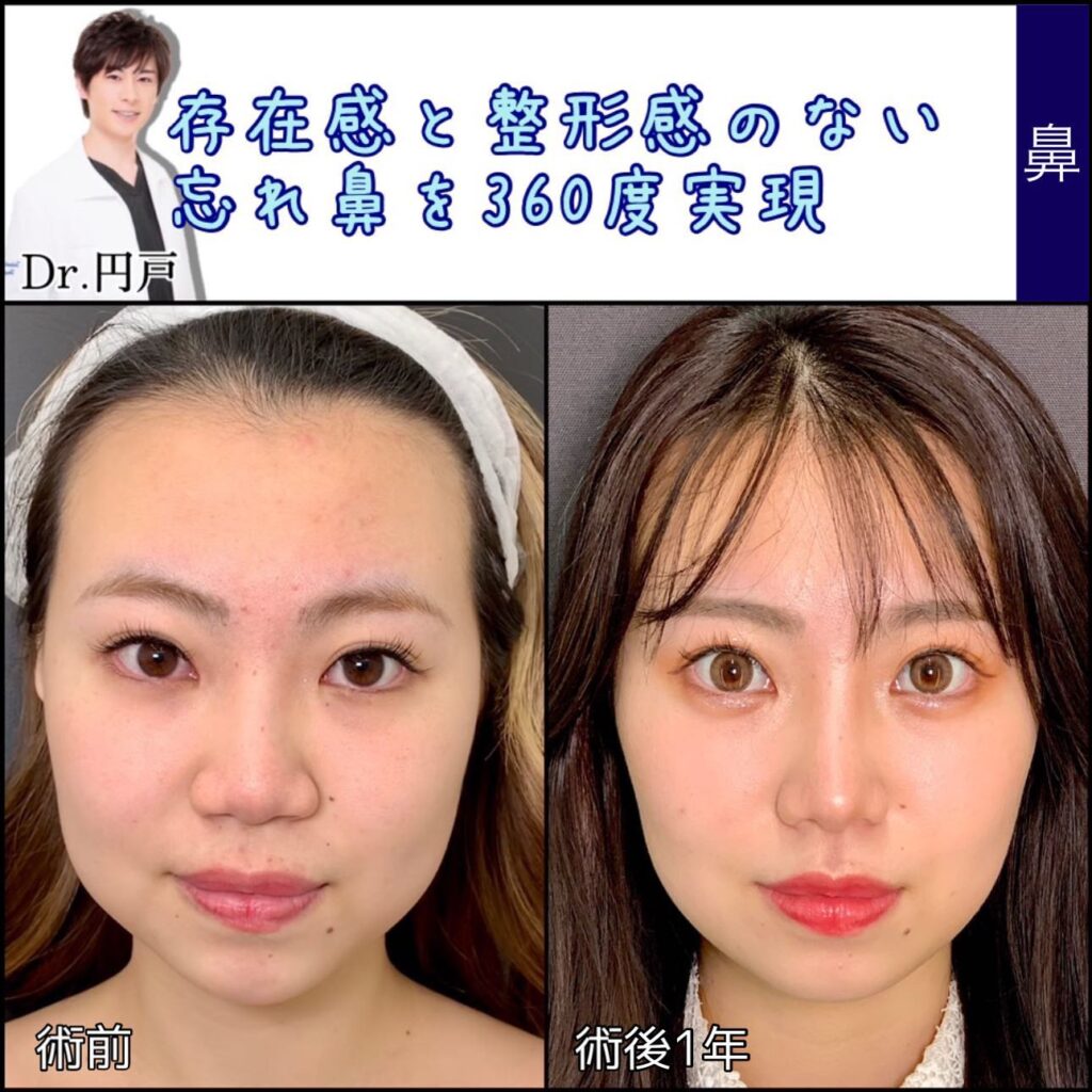 鼻尖形成と軟骨移植と鼻中隔延長と法令線基部人口真皮と鼻背部軟骨移植と小鼻縮小を同時に行った症例写真 (5)