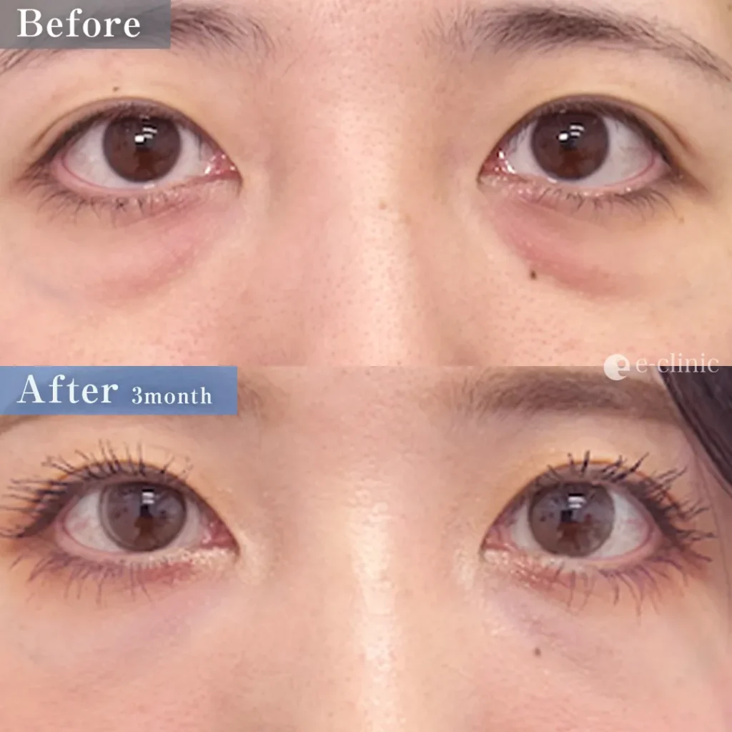 クマ取り_裏ハムラ＋ナノリッチ脂肪注入（伊藤渉）（64）