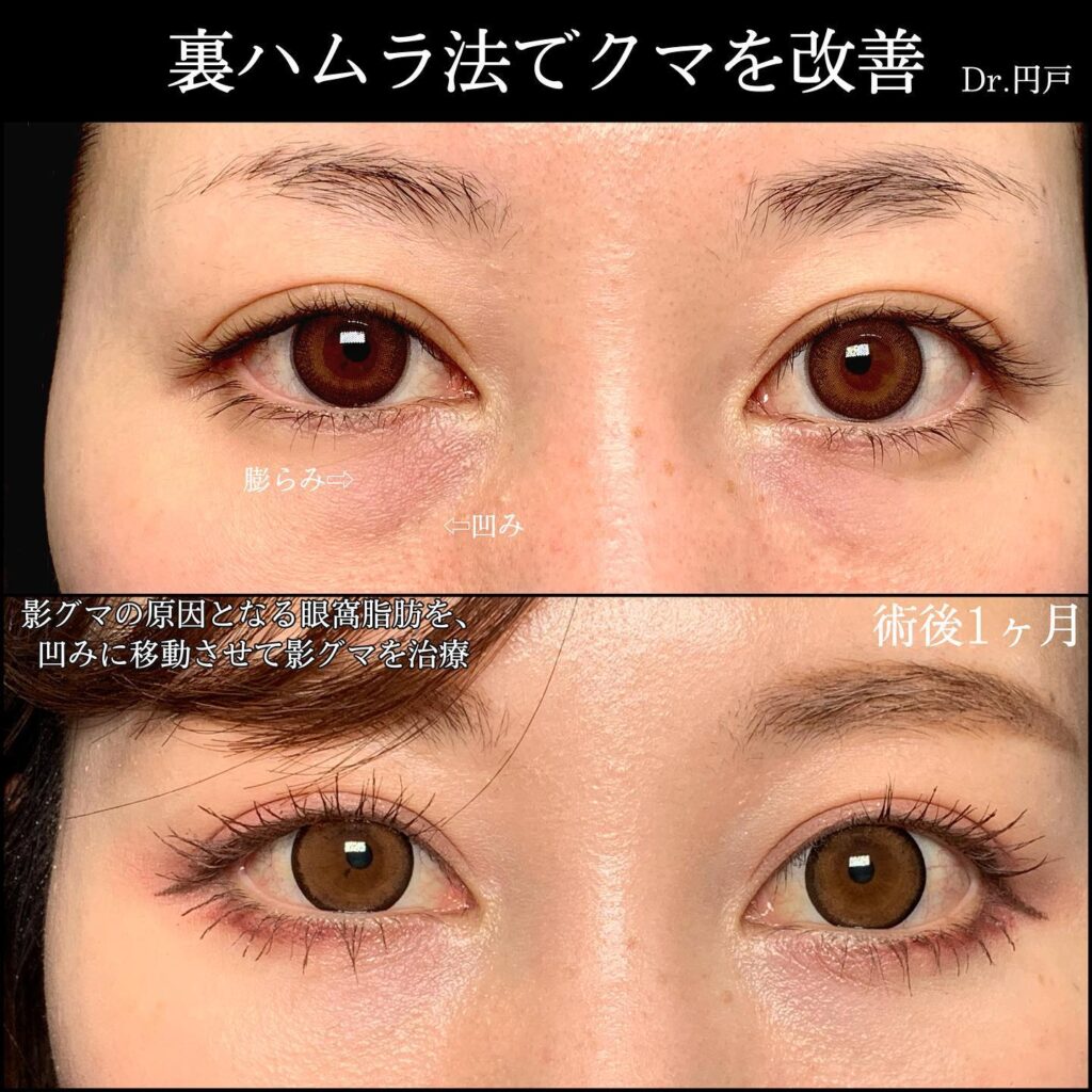 裏ハムラ法の症例写真 (16)