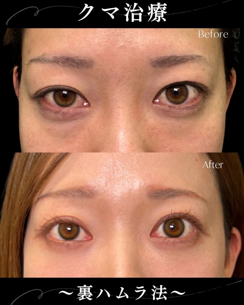 裏ハムラ法の諸例写真 (6)