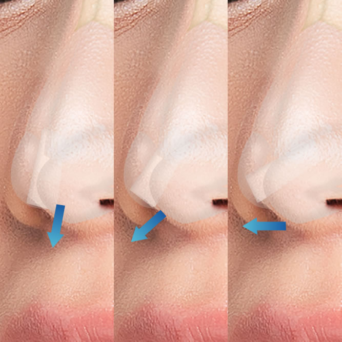 鼻中隔延長の図解
