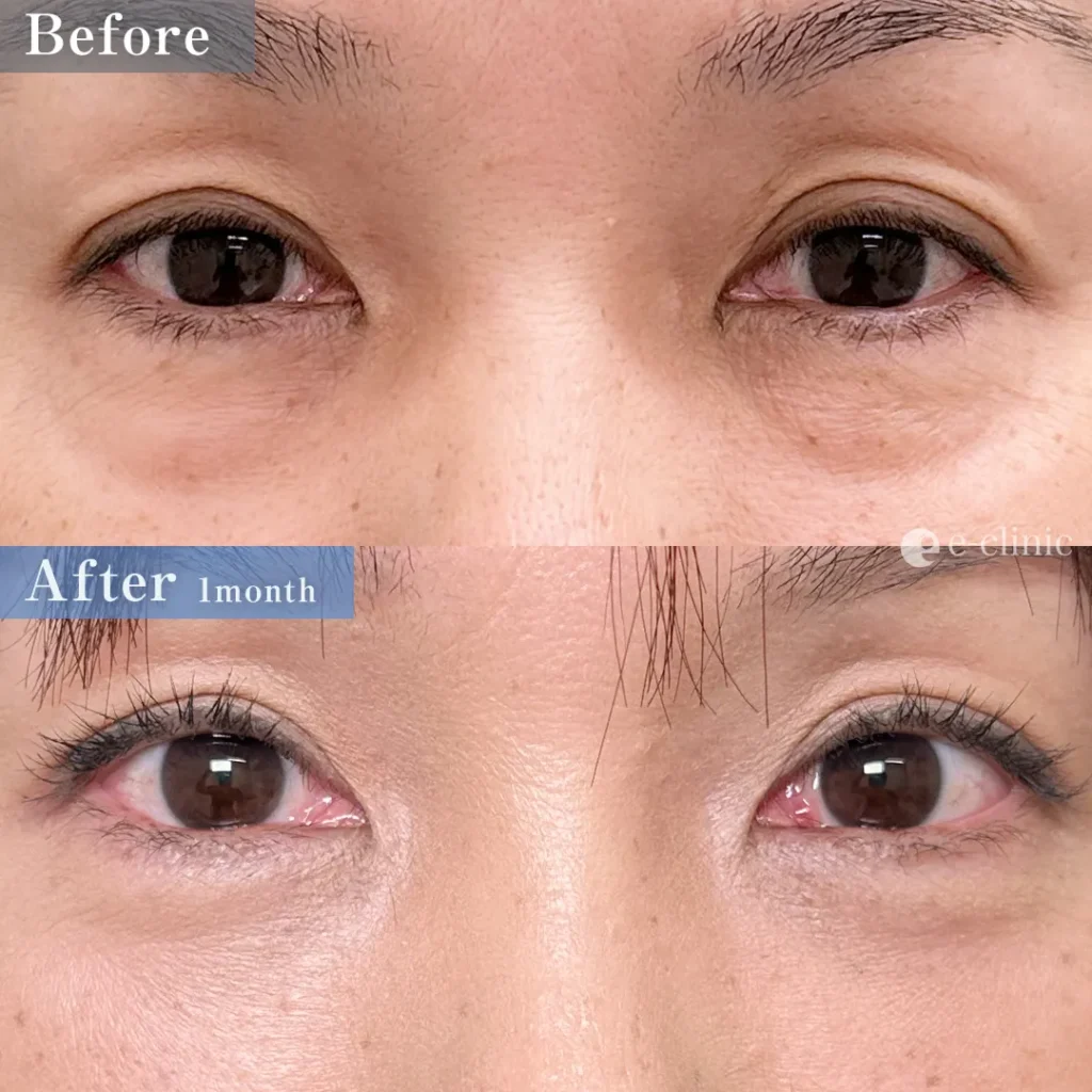 クマ取り_裏ハムラ法（山本彬文）（90）