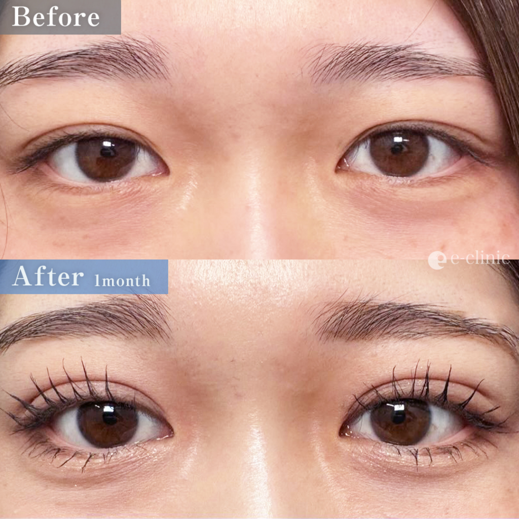 二重埋没法_自然癒着法（八木良太）（79）